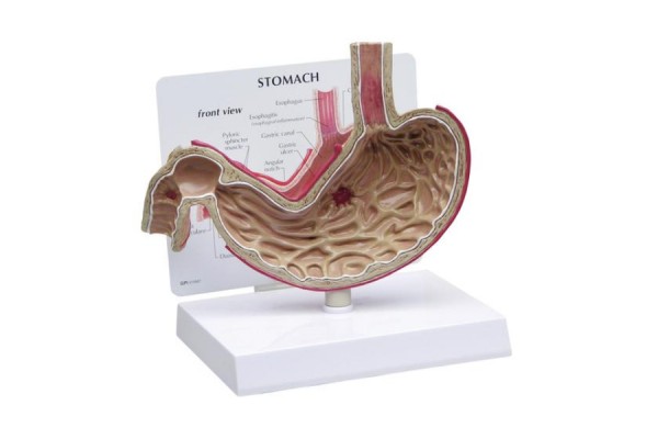 model żołądka z wrzodami - 1019523 3b scientific modele anatomiczne 2